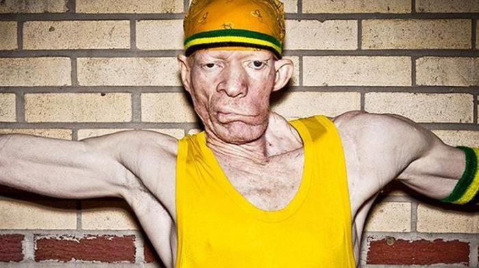 Yellowman Maladie Yellowman Maladie