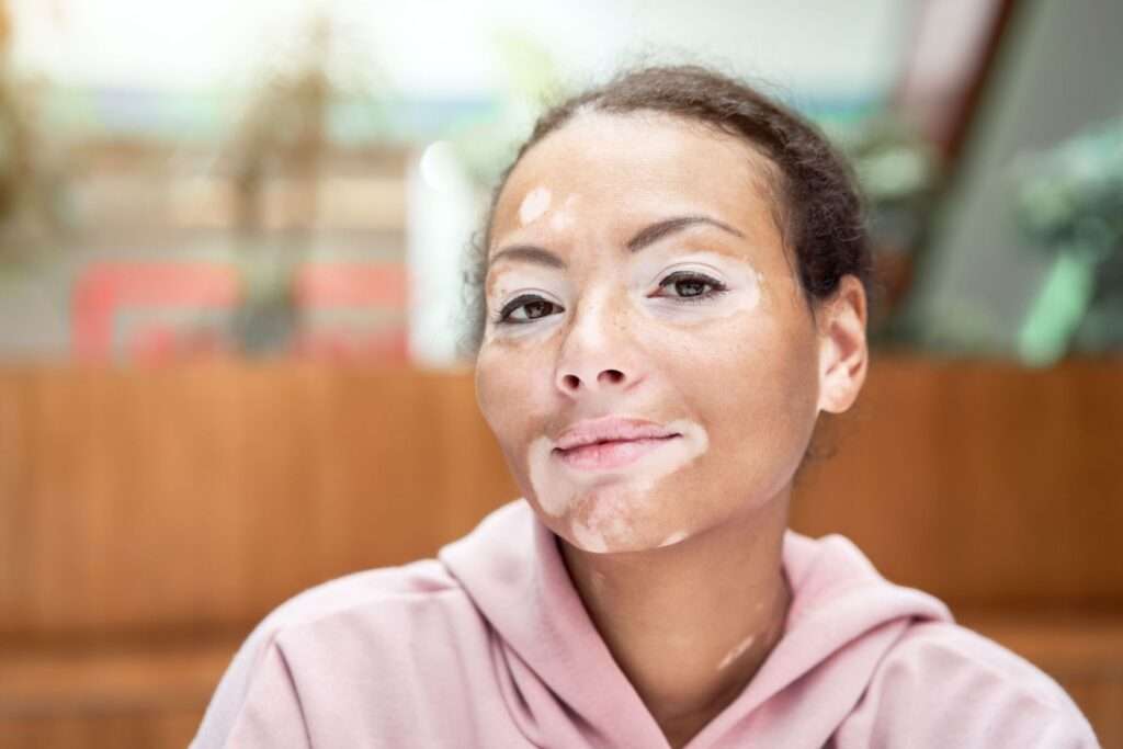 Maladie De Peau Vitiligo