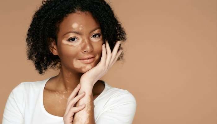 Maladie De Peau Vitiligo